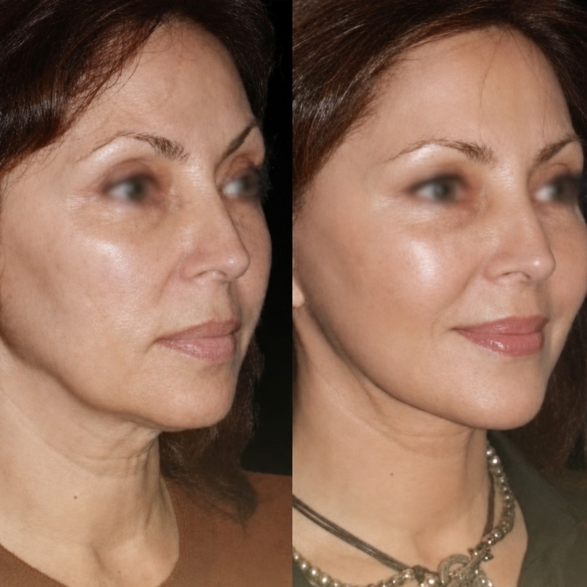 Before and after mini facelift results at Memorial Şişli Hospital, facial rejuvenation visible