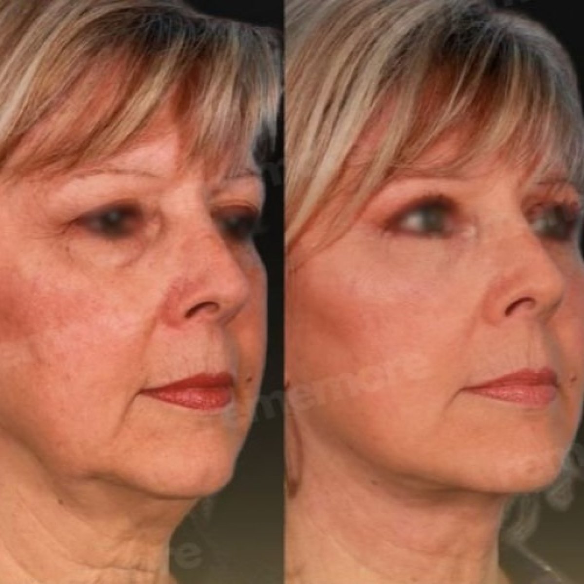 Before and after mini facelift results at Memorial Şişli Hospital, visible facial rejuvenation