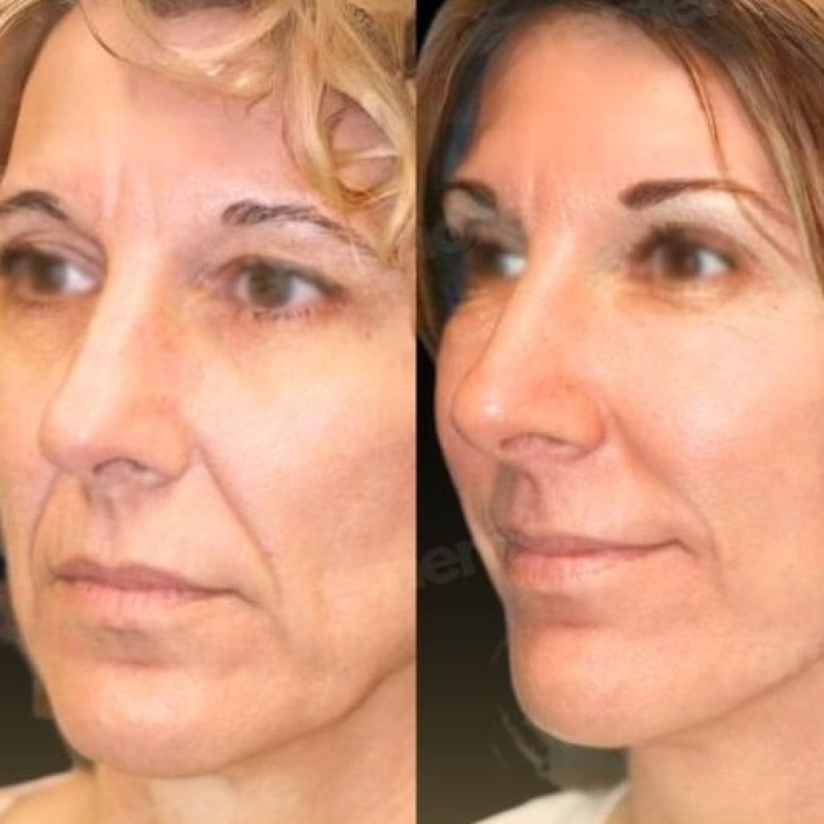 Before and after mini facelift results at Memorial Şişli Hospital, facial rejuvenation outcome