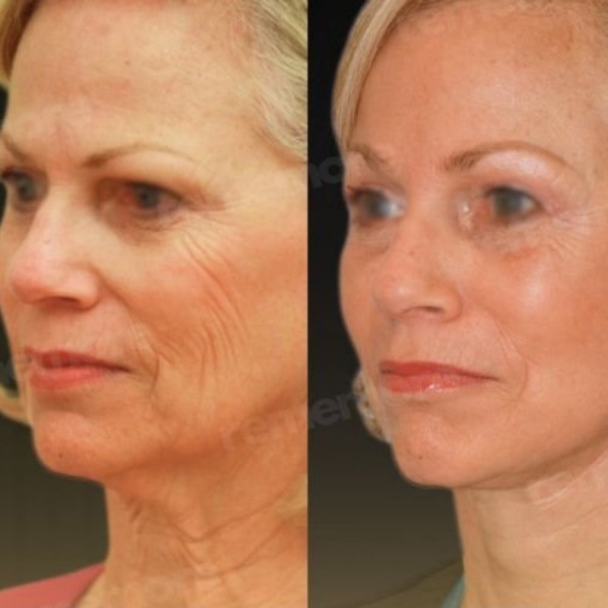 Before and after mini facelift results at Memorial Şişli Hospital, visible facial rejuvenation
