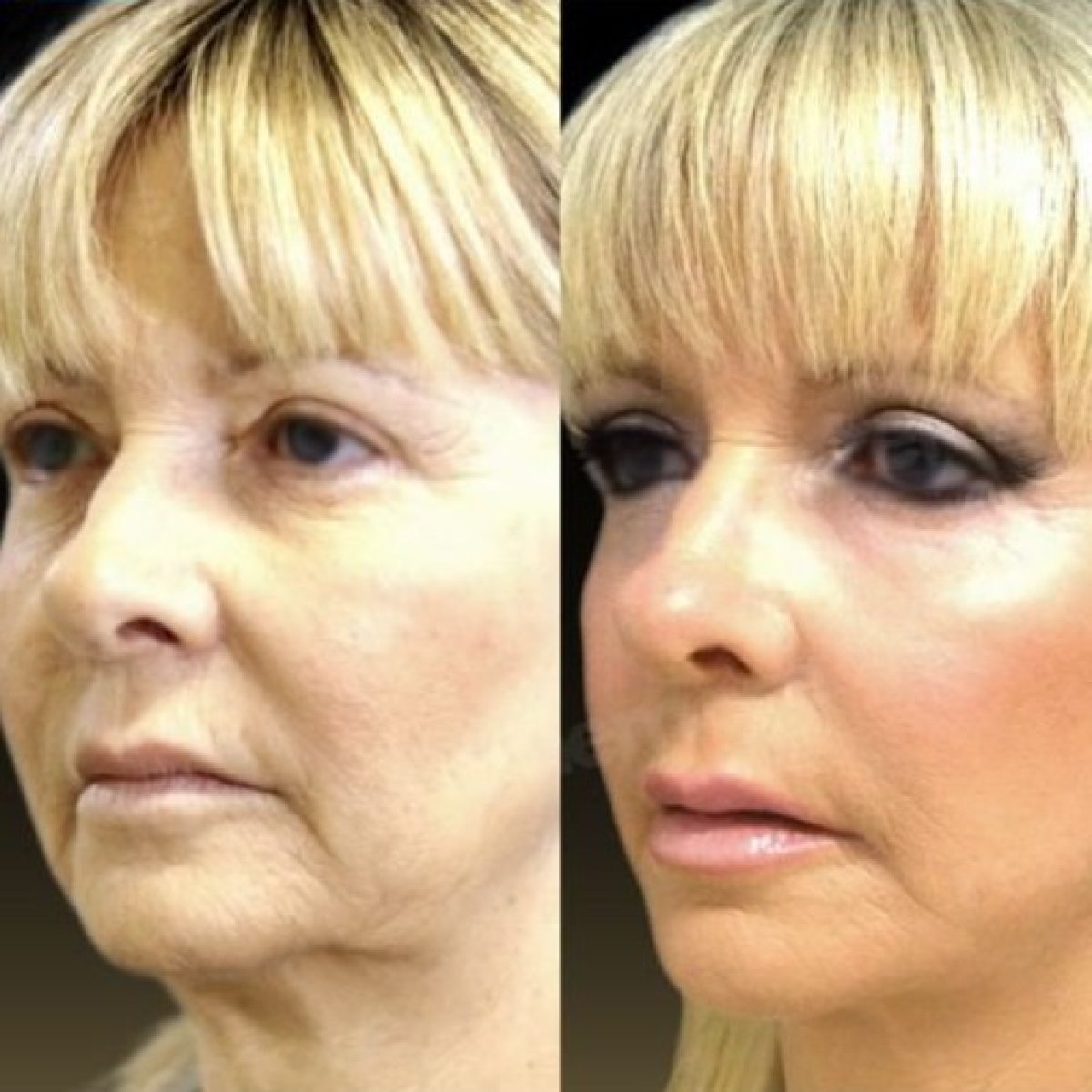 Before and after mini facelift results at Memorial Şişli Hospital, facial rejuvenation visible