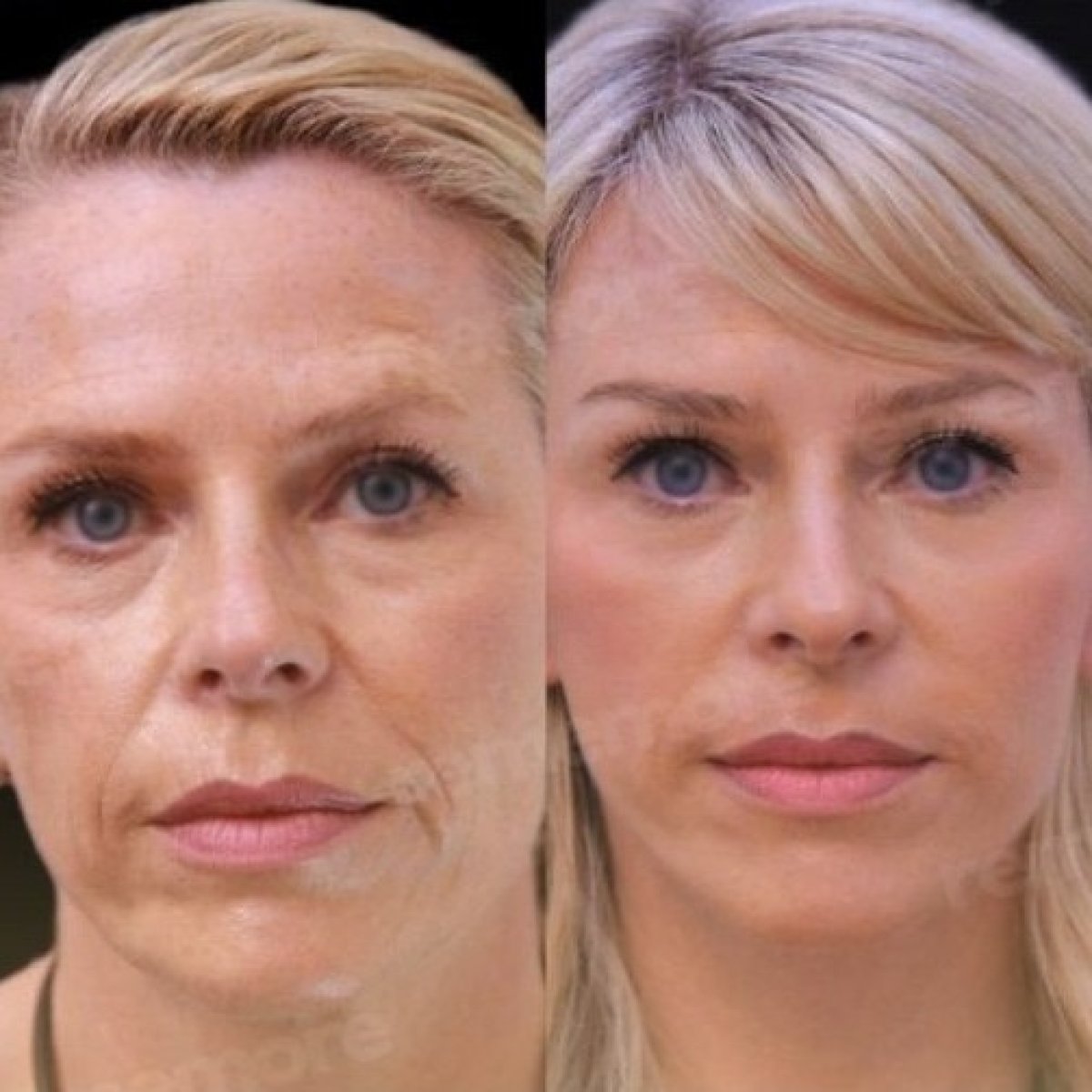 Before and after mini facelift results at Memorial Şişli Hospital, facial rejuvenation visible