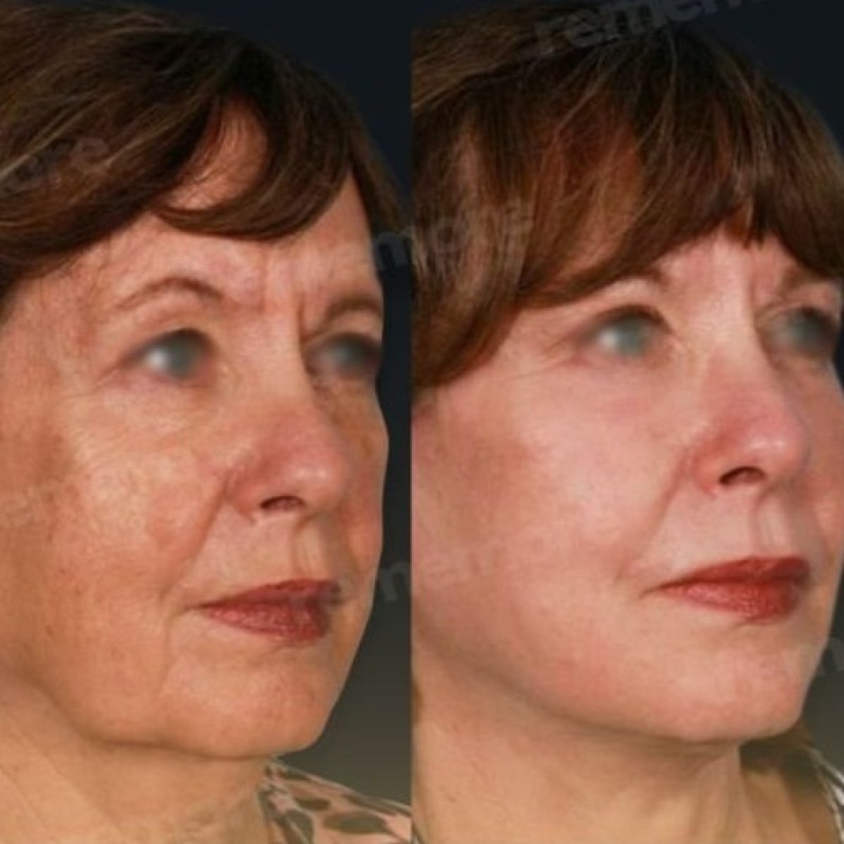 Before and after mini facelift results at Memorial Şişli Hospital, facial rejuvenation visible