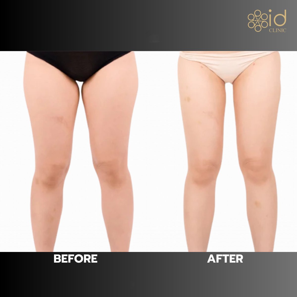 Before and after Vaser liposuction thigh contouring results at ID Clinic Bangkok