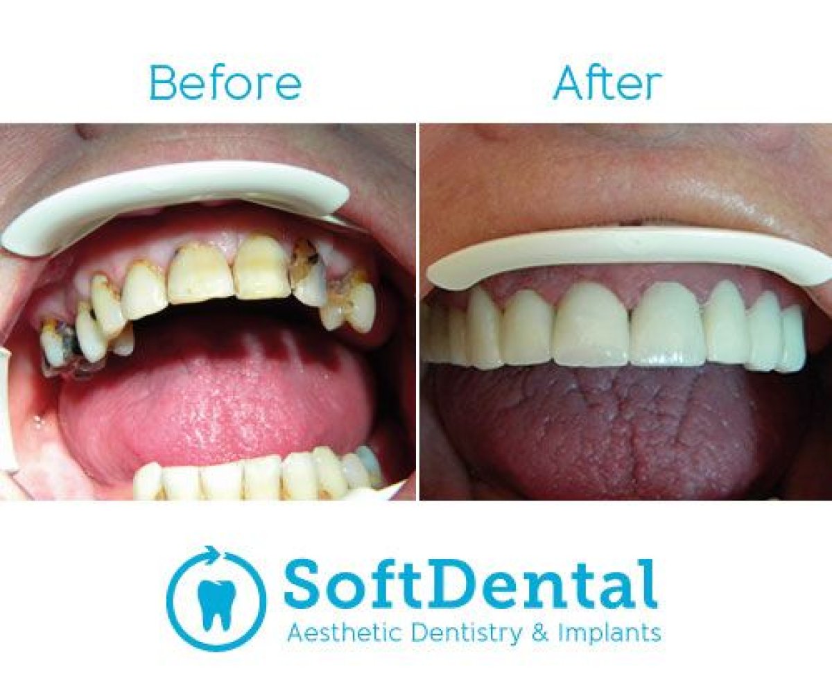 Before and after dental implant with abutment results at SoftDentalCare Clinic, smile restored