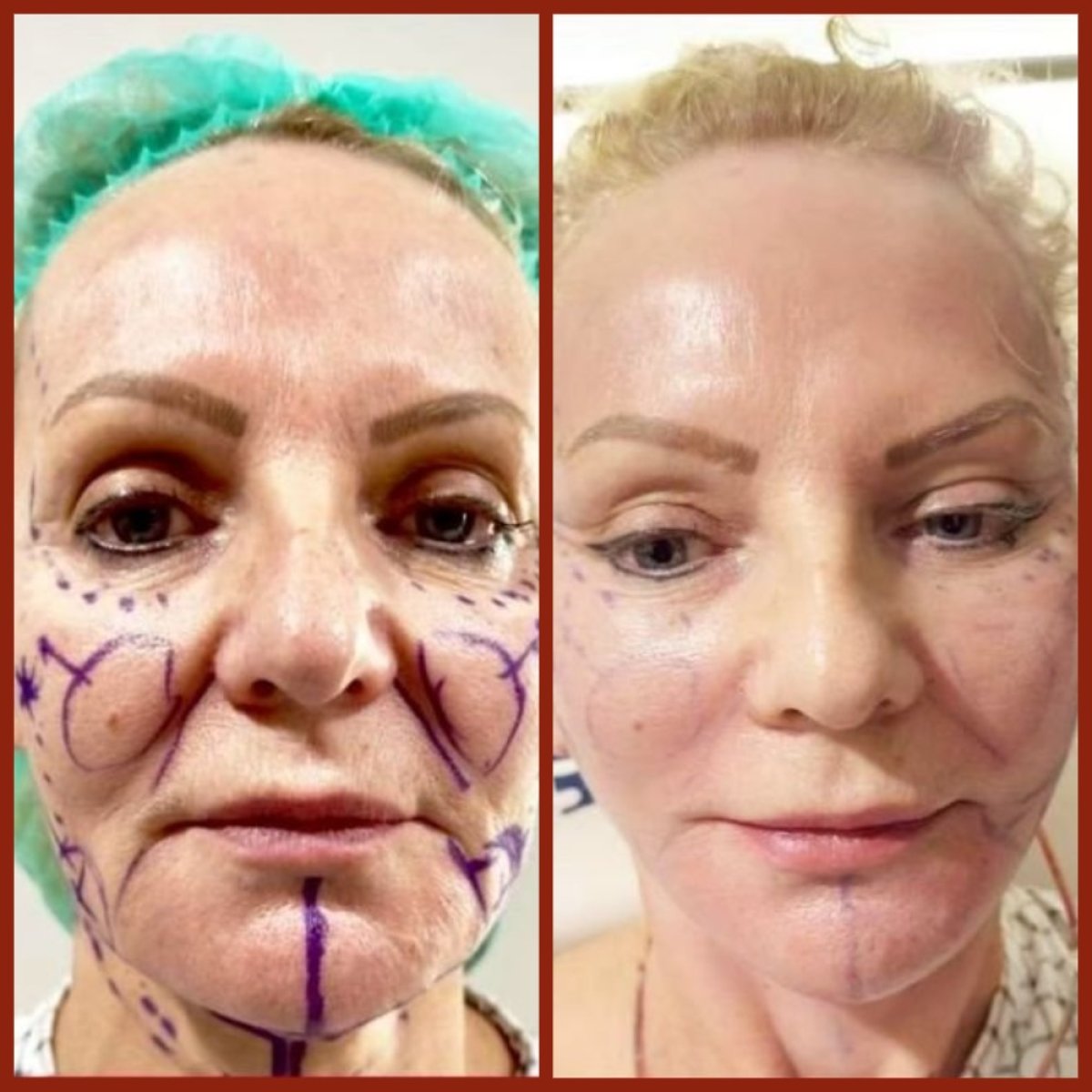 Before and after forehead lift results at DGB Clinic, visible facial rejuvenation outcome
