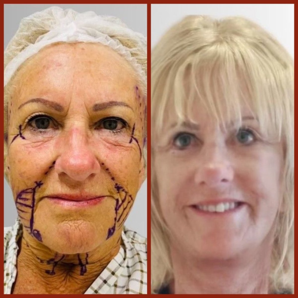 Before and after forehead lift results at DGB Clinic, visible facial rejuvenation and smoother skin