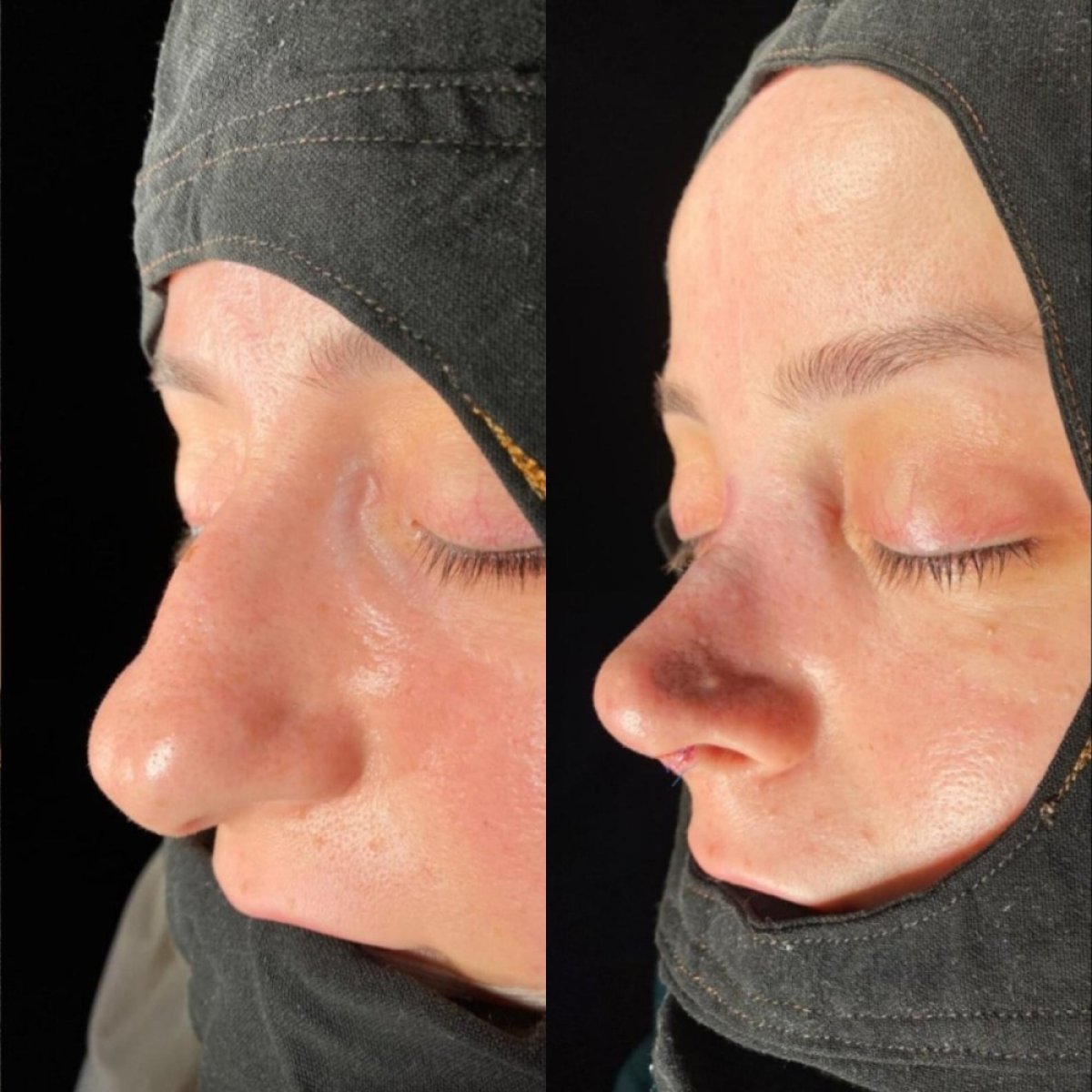 نتائج قبل وبعد عملية تجميل الأنف التصحيحية في ÜMRAN TIP MERKEZİ، تحسين شكل الأنف