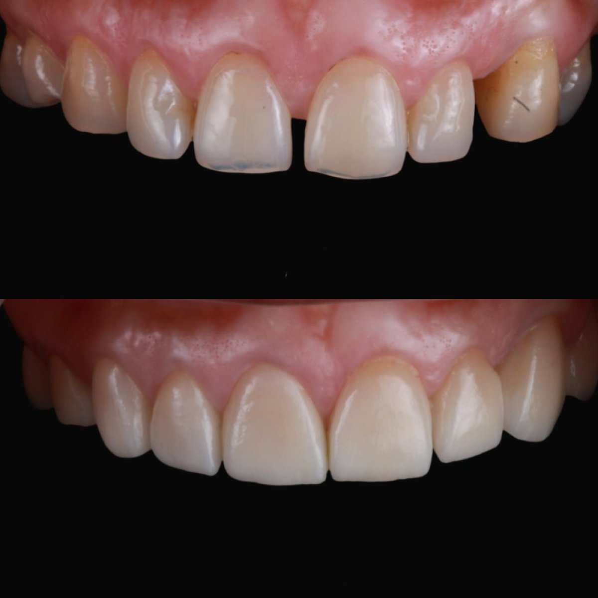 Resultados antes y después de carillas de porcelana en RO Dental Clinic – sonrisa mejorada