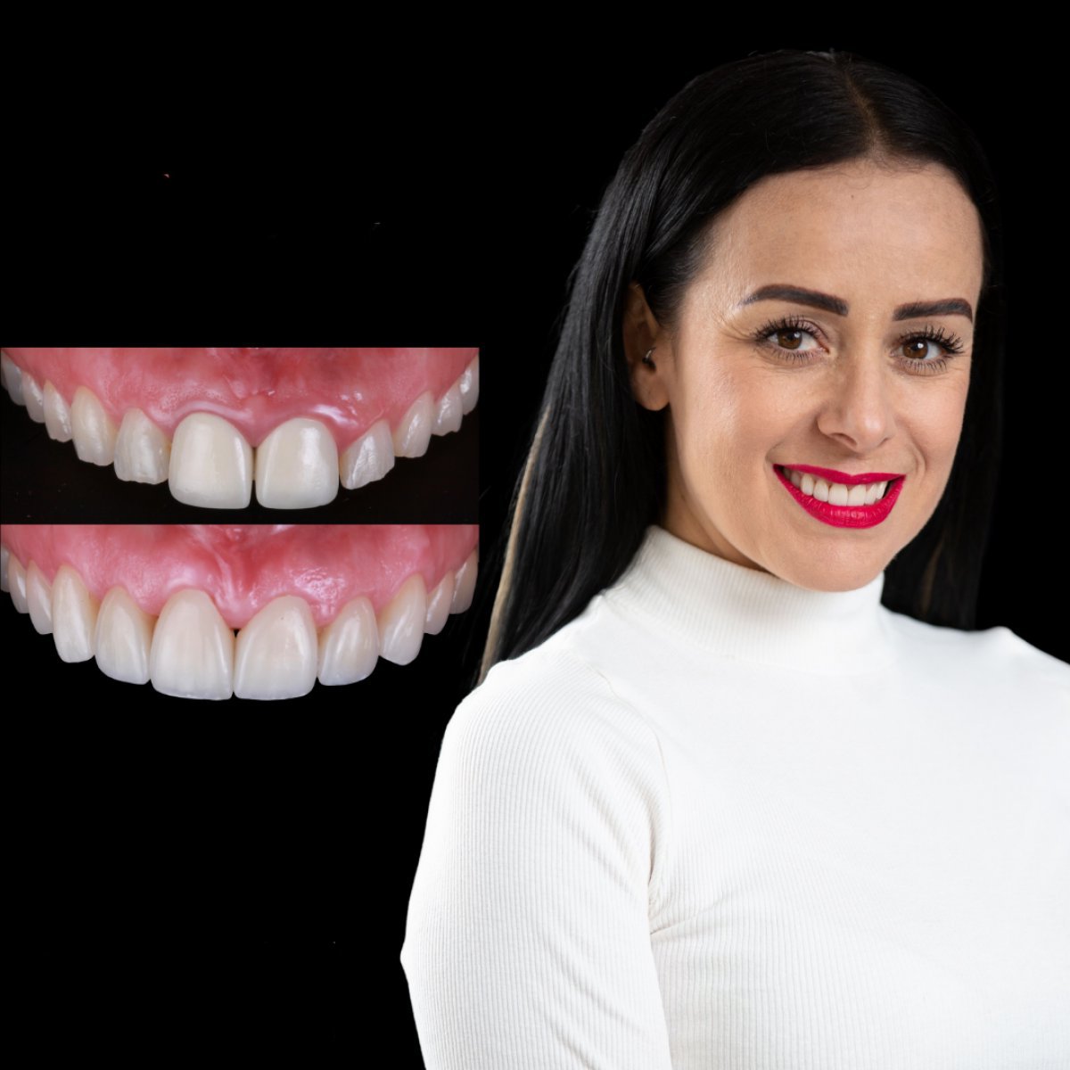 Resultados antes y después de carillas de porcelana en RO Dental Clinic – transformación de sonrisa