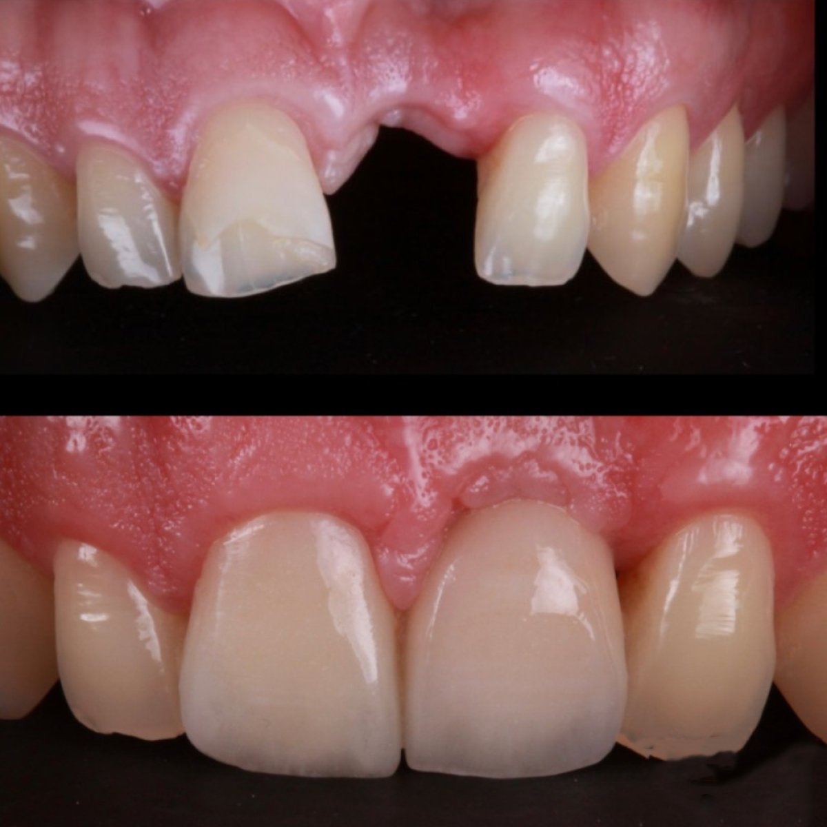 Resultados antes y después de carillas de porcelana en RO Dental Clinic – estética dental frontal