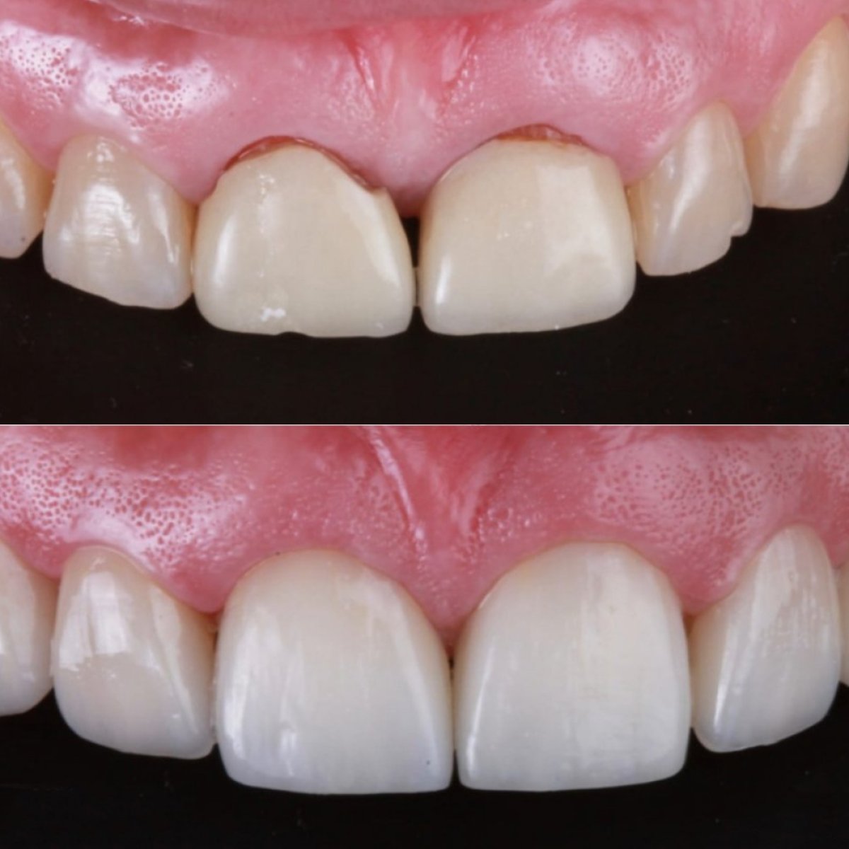 Resultados antes y después de carillas de porcelana en RO Dental Clinic – sonrisa mejorada