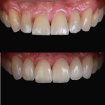Porcelain Veneer results by Dr. Samuel Guevara Gomez - Patient’s before and after images Before and after Porcelain Veneer photos by Dr. Samuel Guevara Gomez