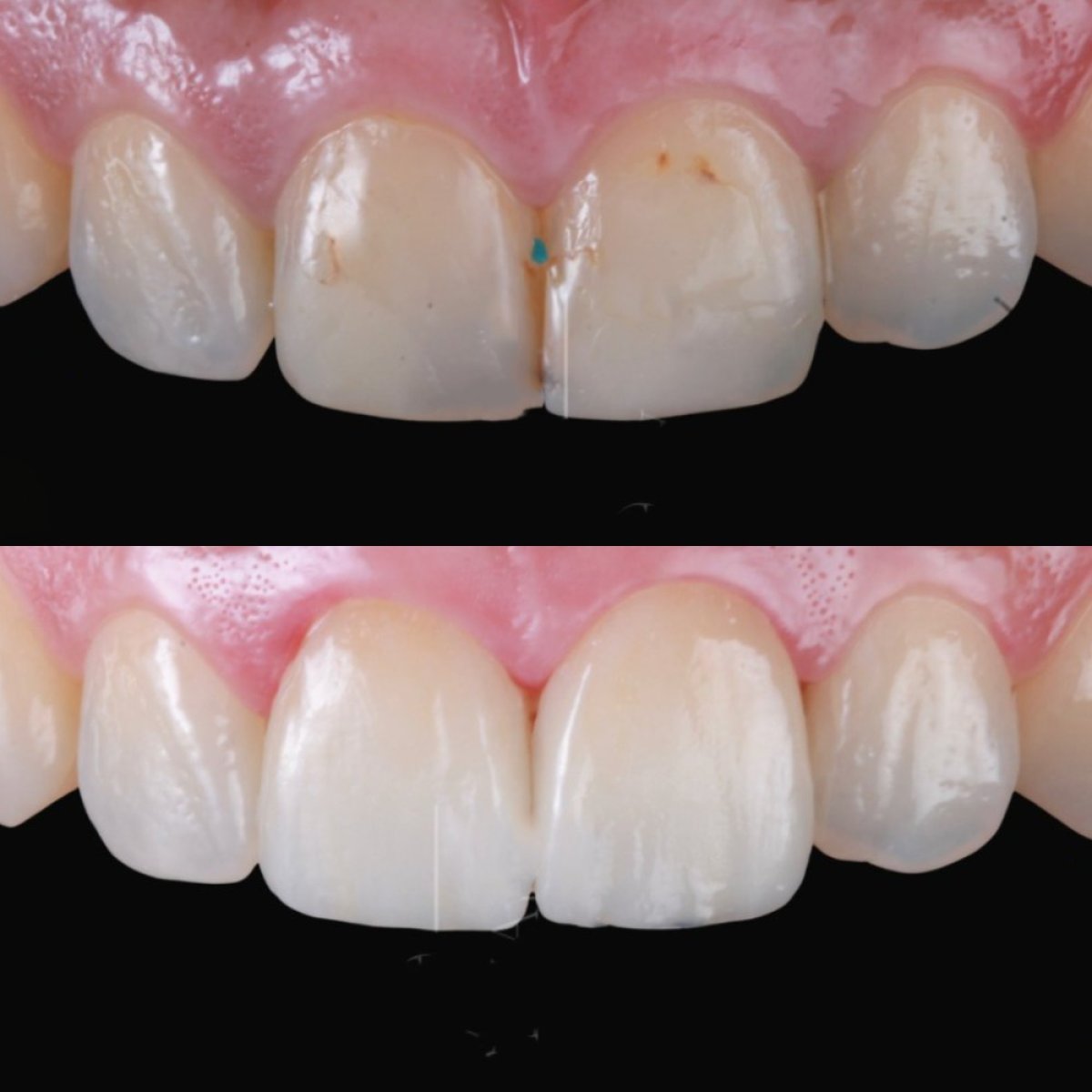 Resultados antes y después de carillas de porcelana en RO Dental Clinic – estética dental mejorada