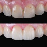 Porcelain Veneer results by Dr. Samuel Guevara Gomez - Patient’s before and after images Before and after Porcelain Veneer photos by Dr. Samuel Guevara Gomez