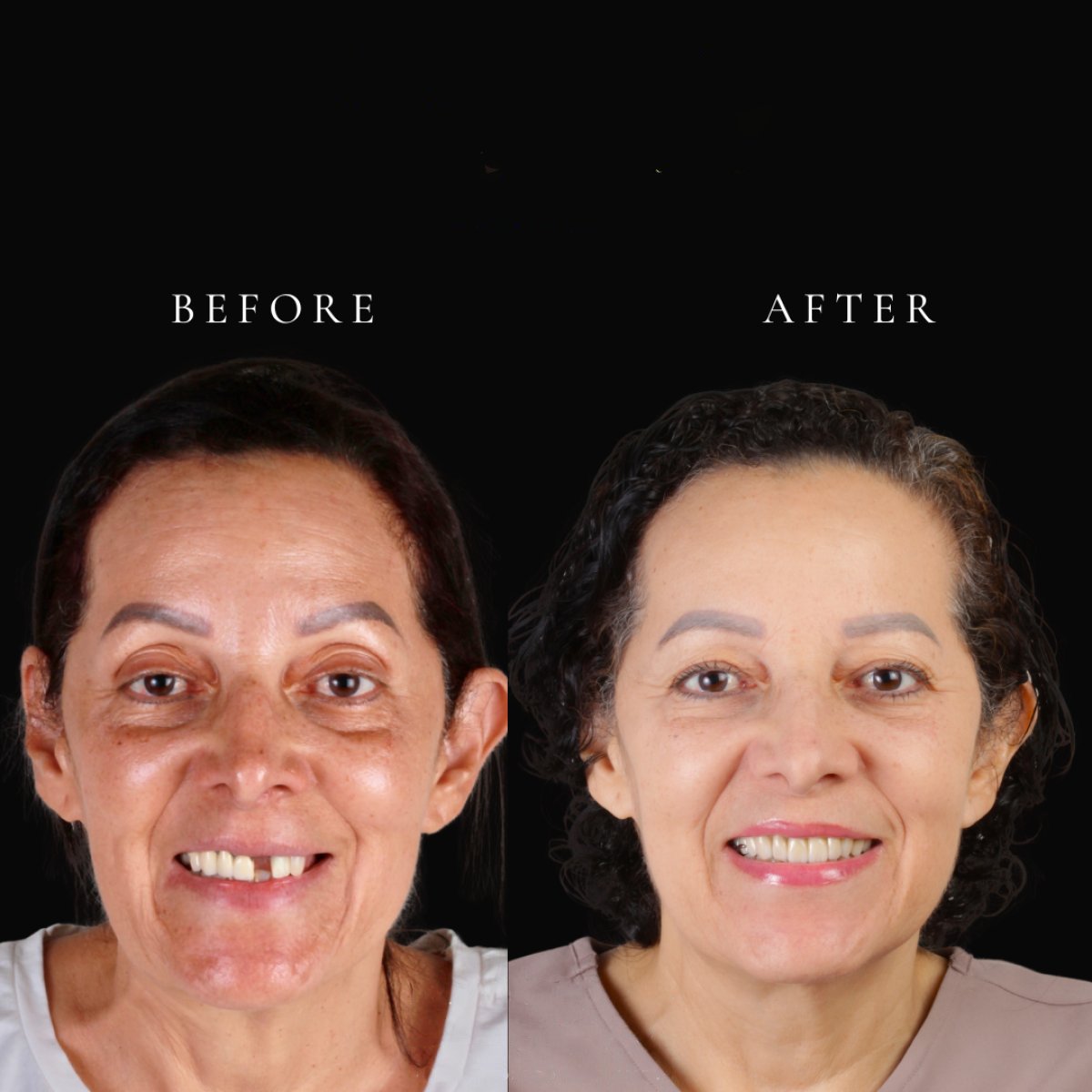 قبل وبعد تركيب جسر الأسنان في RO Dental Clinic، نتيجة استعادة الابتسامة