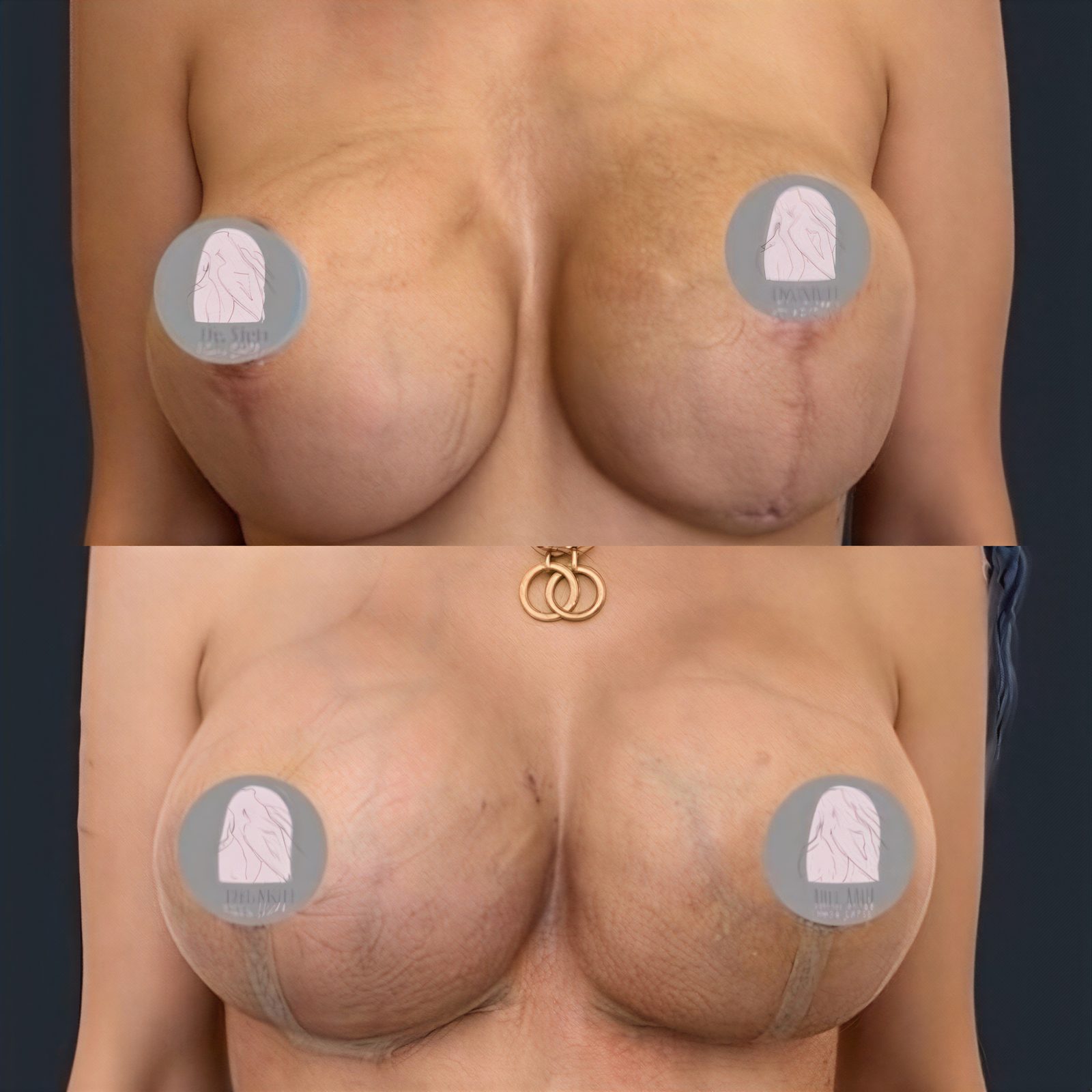 Antes y después de implantes mamarios con lifting en Dr. MED, resultado mejorado