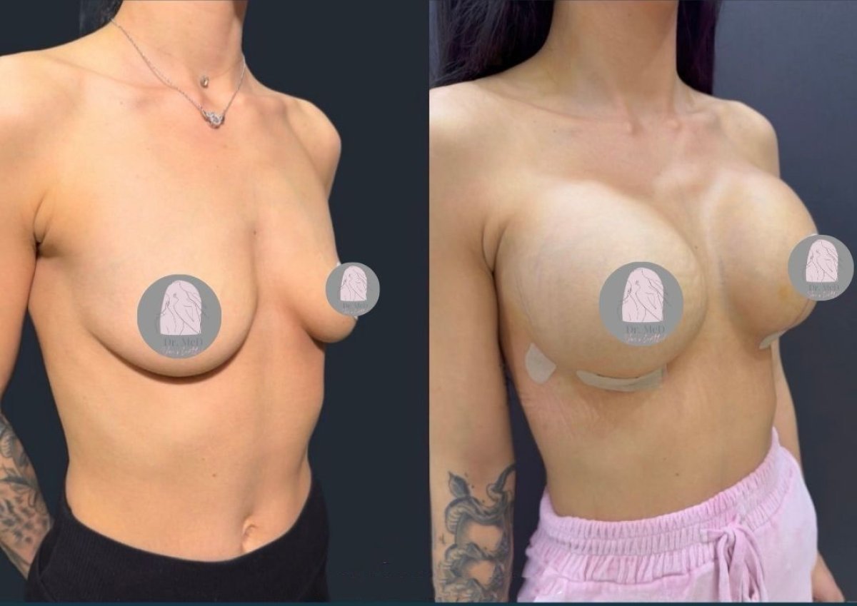 Avant/après implants mammaires avec lifting chez Dr. MED – forme et volume améliorés