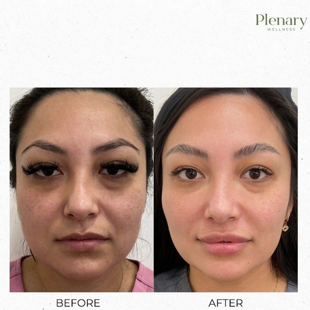 نتائج علاج الوجه بالبلازما PRP قبل وبعد في Plenary Wellness، تحسين ملمس البشرة