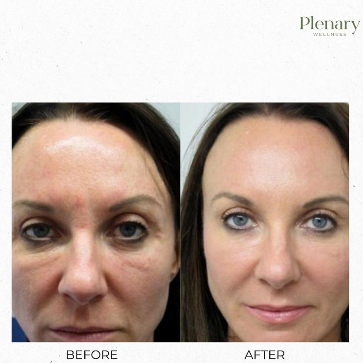 نتائج تجديد شباب الوجه بحقن البلازما PRP قبل وبعد في عيادة Plenary Wellness