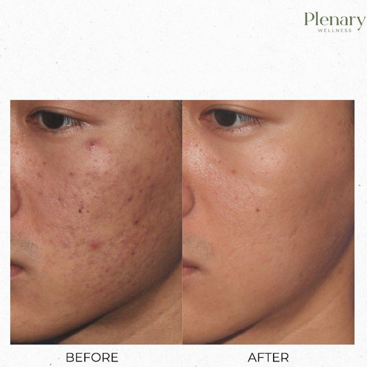 Antes y después de terapia PRP para cicatrices de acné en Plenary Wellness, mejora visible