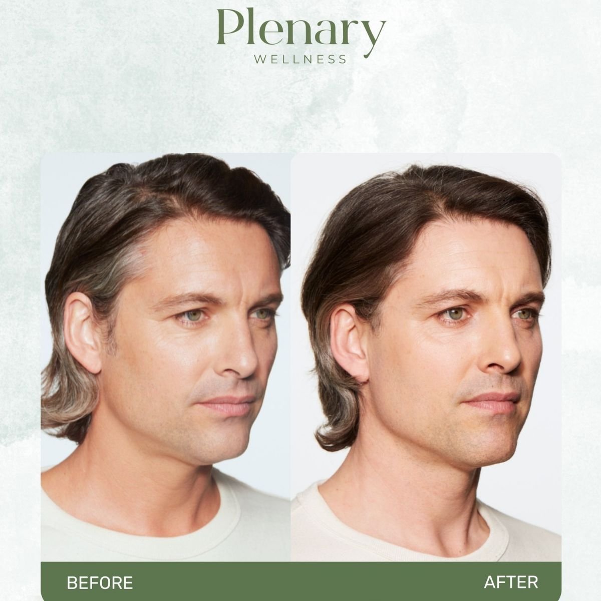 Vorher-nachher-Ergebnis Filler-Injektion bei Plenary Wellness, sichtbare Verjüngung