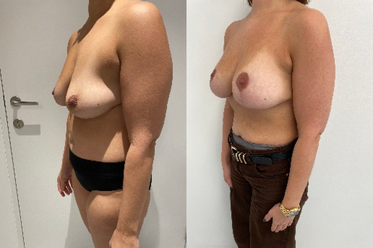Résultats avant/après lifting des seins avec implants ronds, forme et volume améliorés