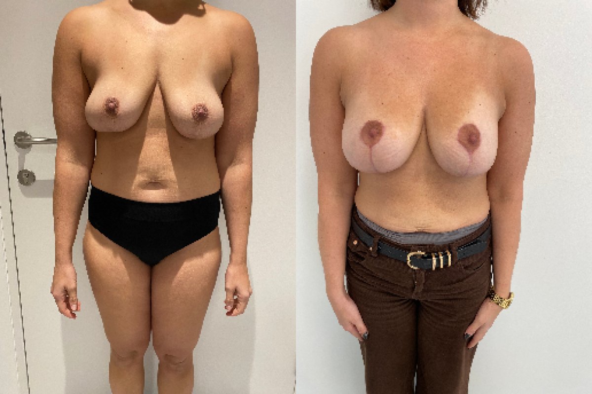 Résultats avant/après lifting mammaire avec implants ronds – forme et volume améliorés