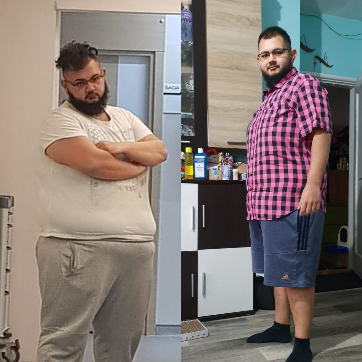 Resultados antes y después de bypass gástrico en Assoc.Prof.Dr.Cemal Kara / Medical Park İzmir Hospital