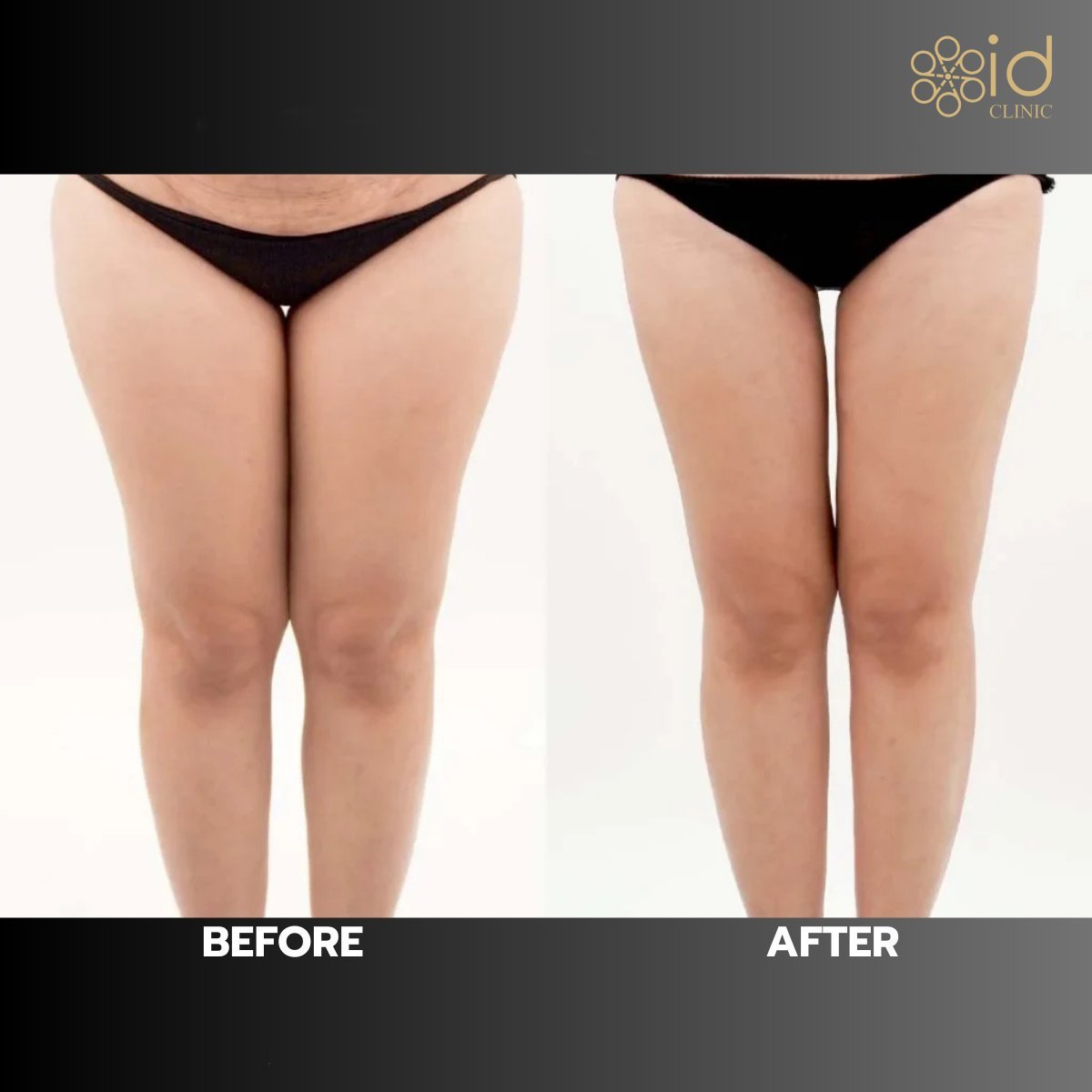 Before and after thigh lift results at ID Clinic Bangkok – slimmer, contoured thighs