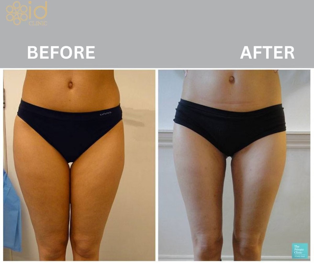 Before and after thigh lift results at ID Clinic Bangkok, visible thigh contour improvement