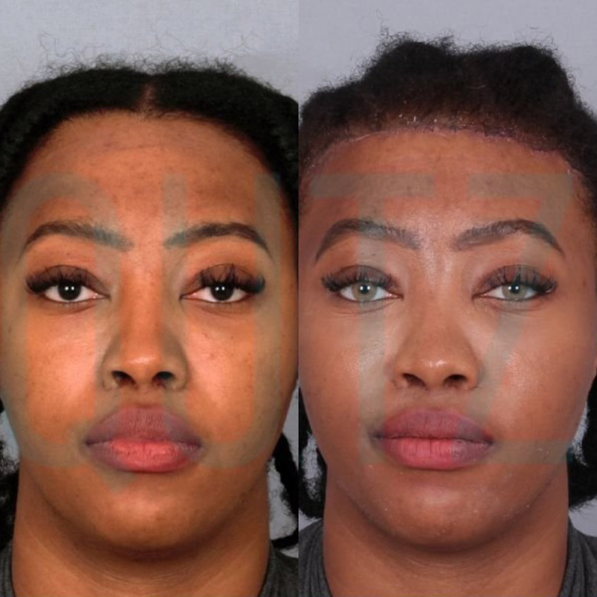 Forehead lift before and after results at Quartz Hospital, visible brow elevation improvement