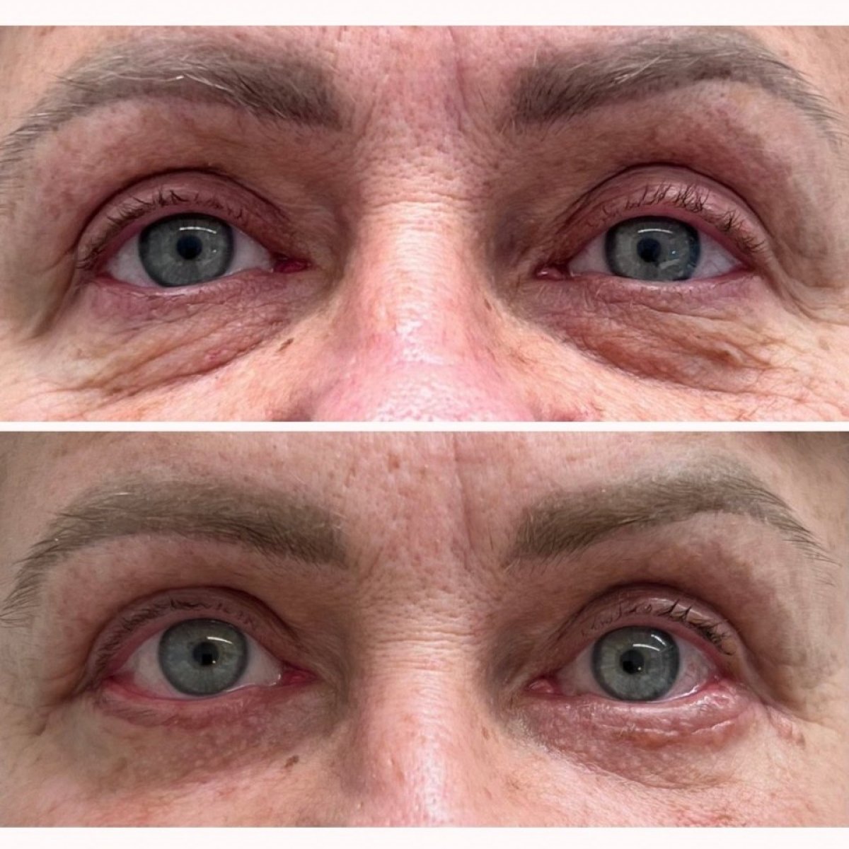 Lower eyelid blepharoplasty before and after results at RMED Kopernika, reduced under-eye bags