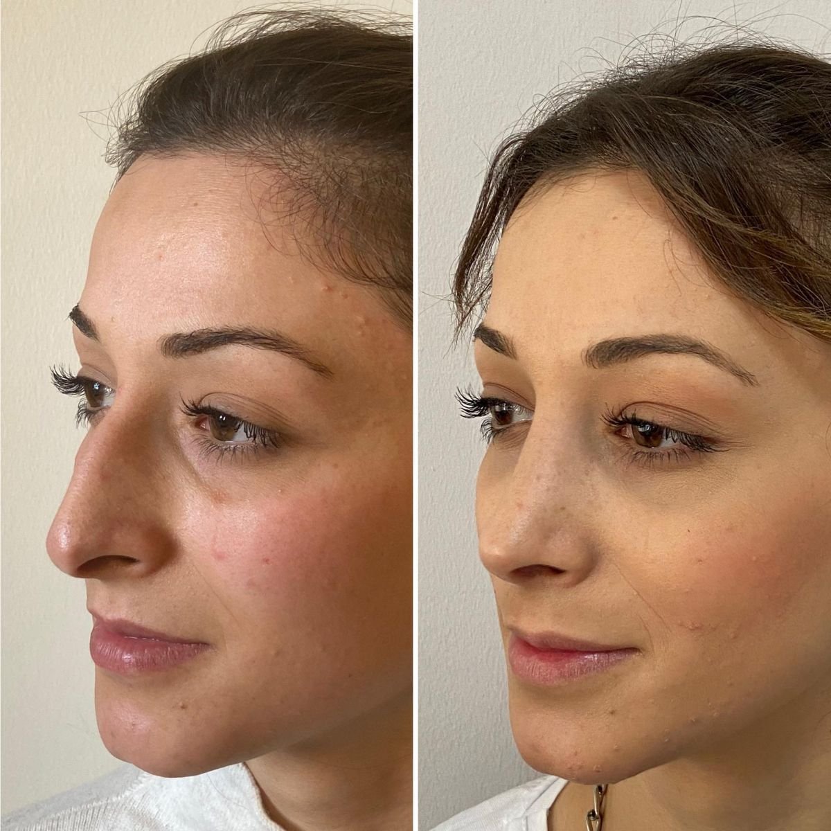 Resultados de rinoplastia antes y después en Assoc.Prof.Dr.Cemal Kara / Medical Park İzmir Hospital