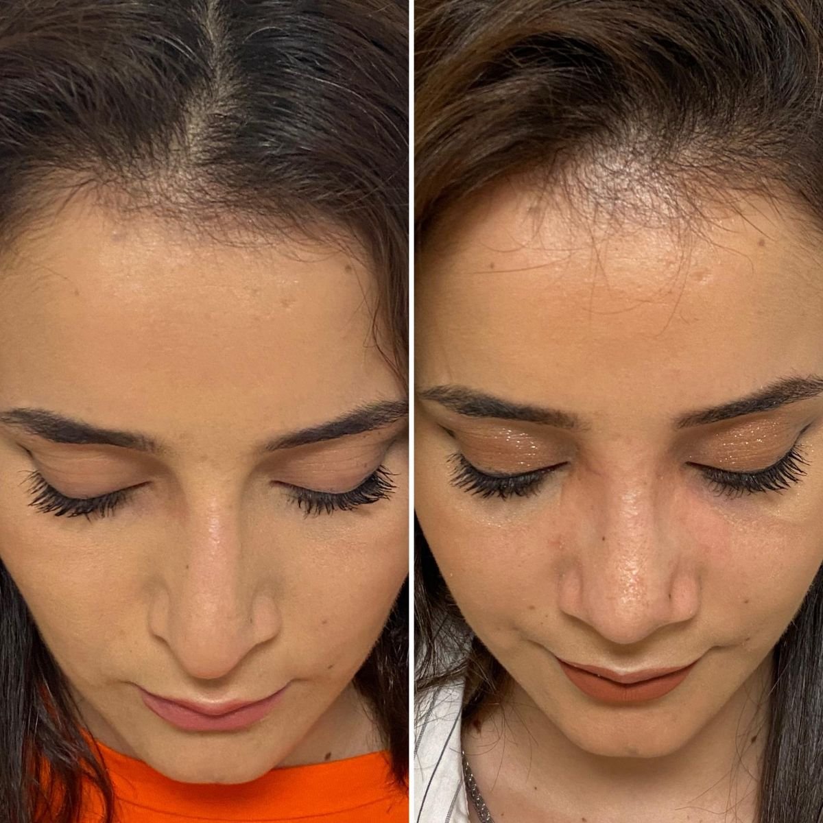 Résultats avant et après rhinoplastie chez Assoc.Prof.Dr.Cemal Kara / Medical Park İzmir Hospital