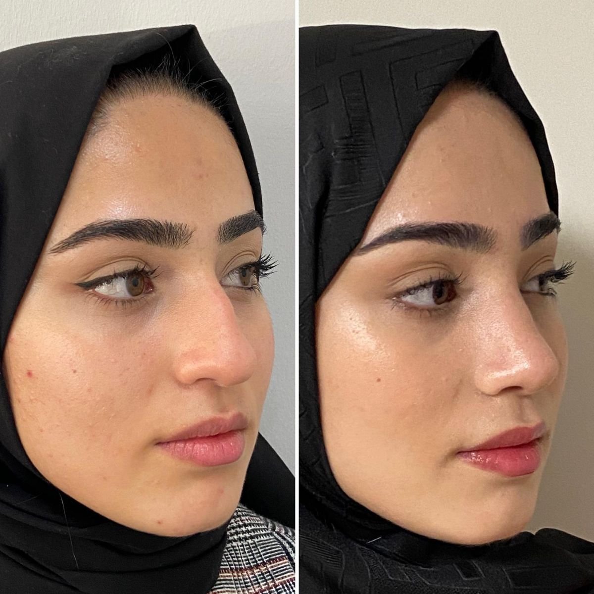 Résultats avant et après rhinoplastie chez Assoc.Prof.Dr.Cemal Kara / Medical Park İzmir Hospital