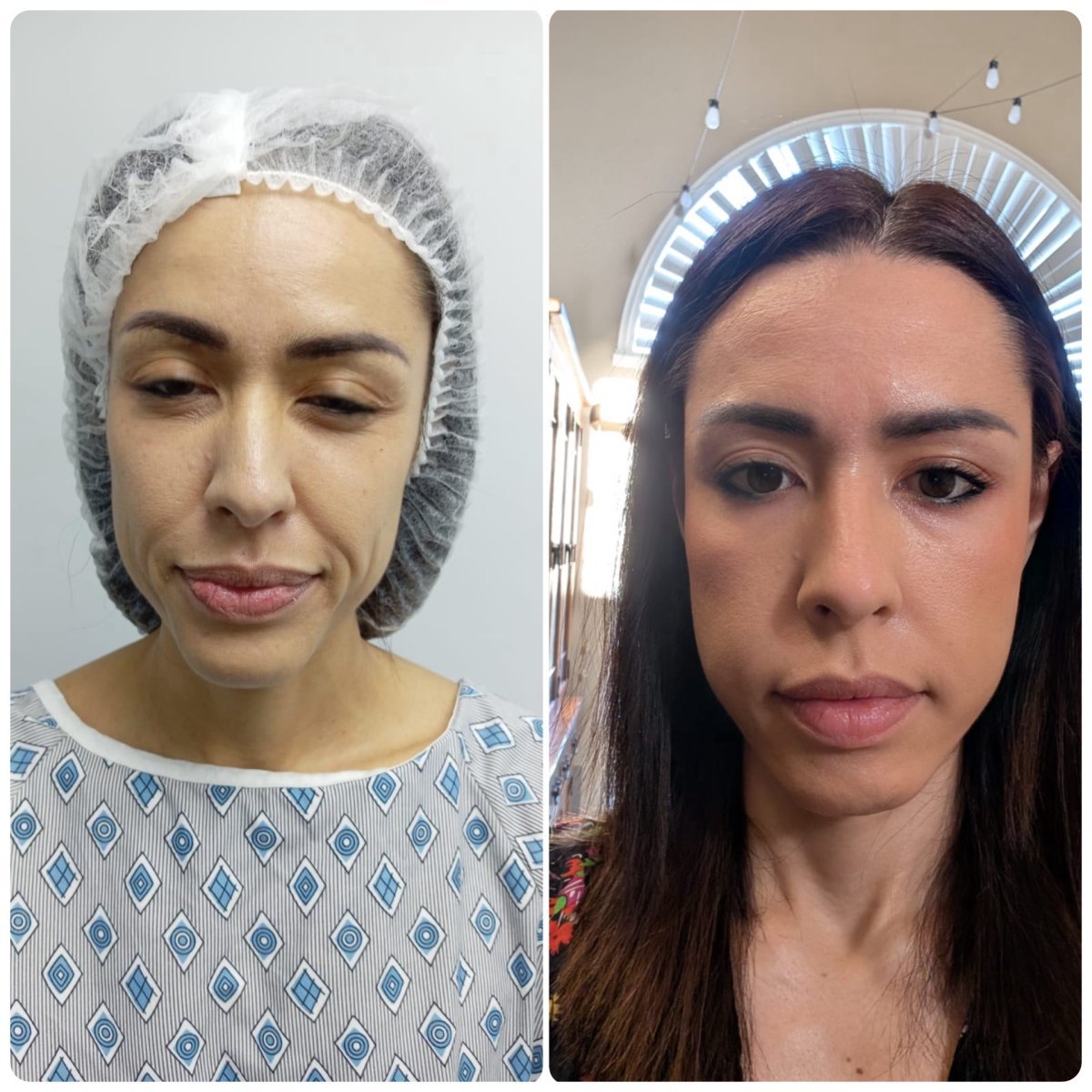Before and after facelift results at Hospital de la Familia, facial rejuvenation procedure