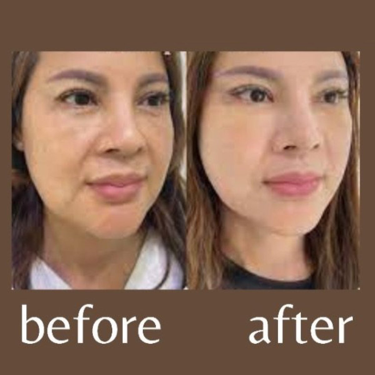 Before and after mini facelift results at ID Clinic Bangkok, visible facial rejuvenation