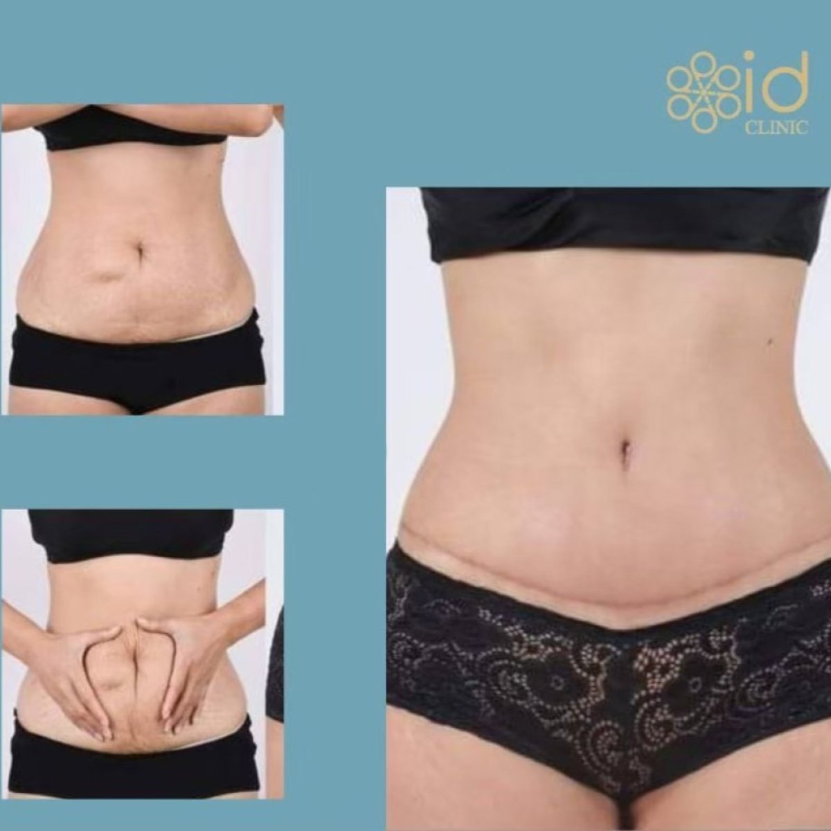 Before and after tummy tuck results at ID Clinic Bangkok, improved abdominal contour