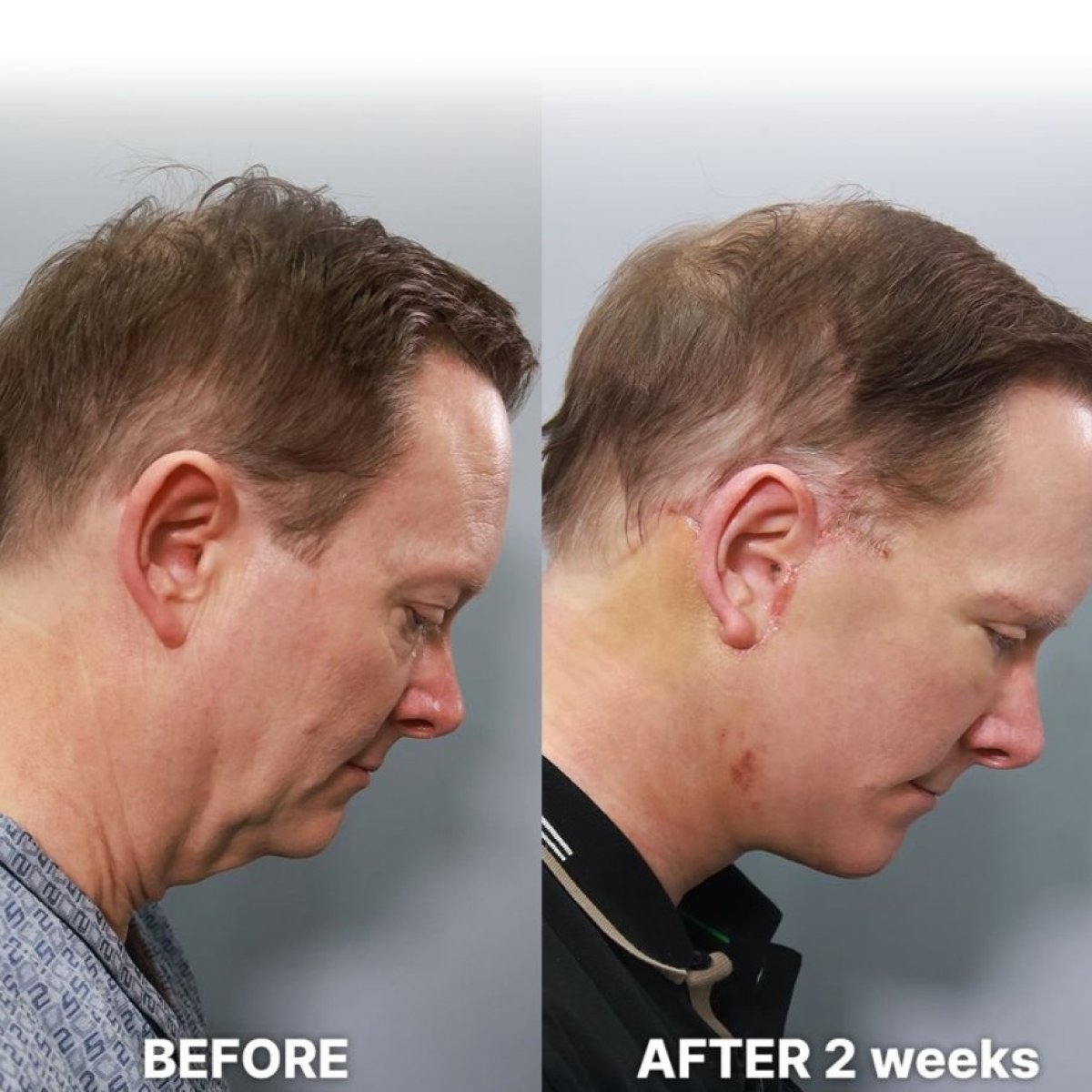 Facelift before and after results at Returning Plastic Surgery, visible neck and jawline improvement