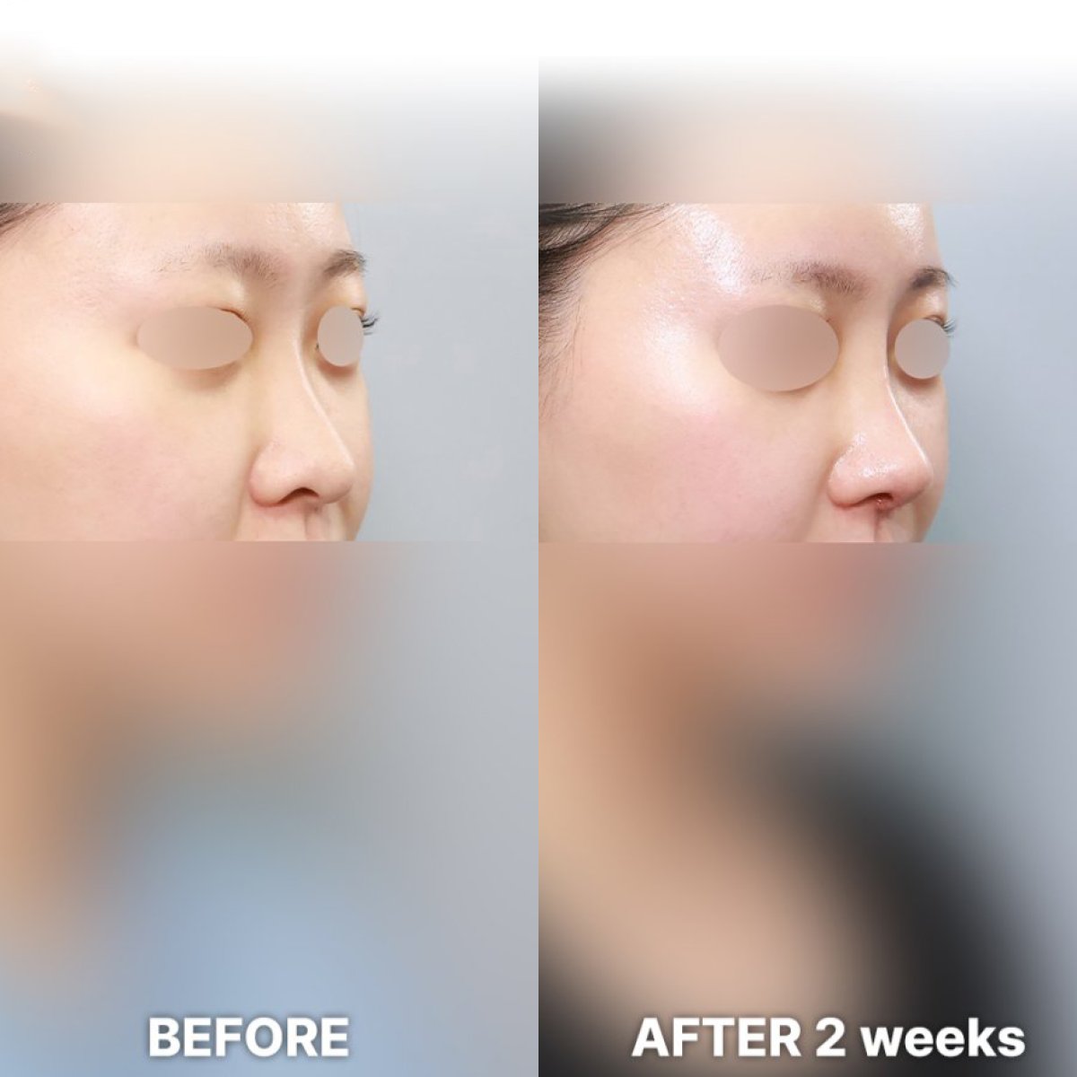 Before and after rhinoplasty results at Returning Plastic Surgery, nose reshaping after 2 weeks