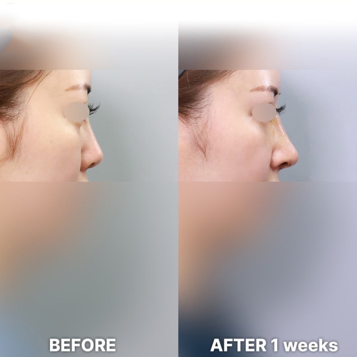 Before and after rhinoplasty results at Returning Plastic Surgery, nose reshaping after 1 week