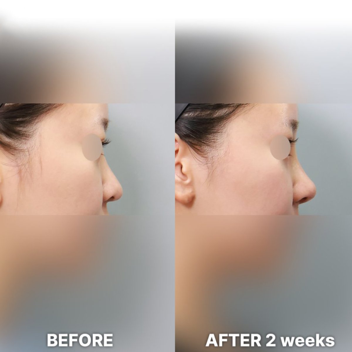 Результати ринопластики до і після в Returning Plastic Surgery, корекція носа через 2 тижні
