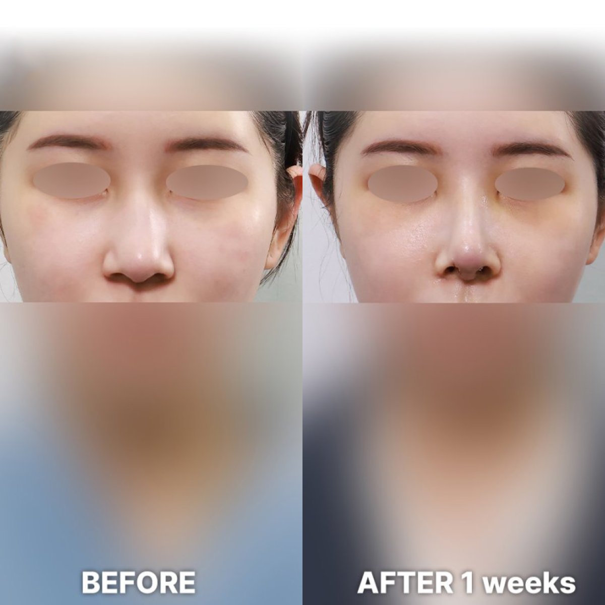 Before and after rhinoplasty results at Returning Plastic Surgery, nose reshaping after 1 week