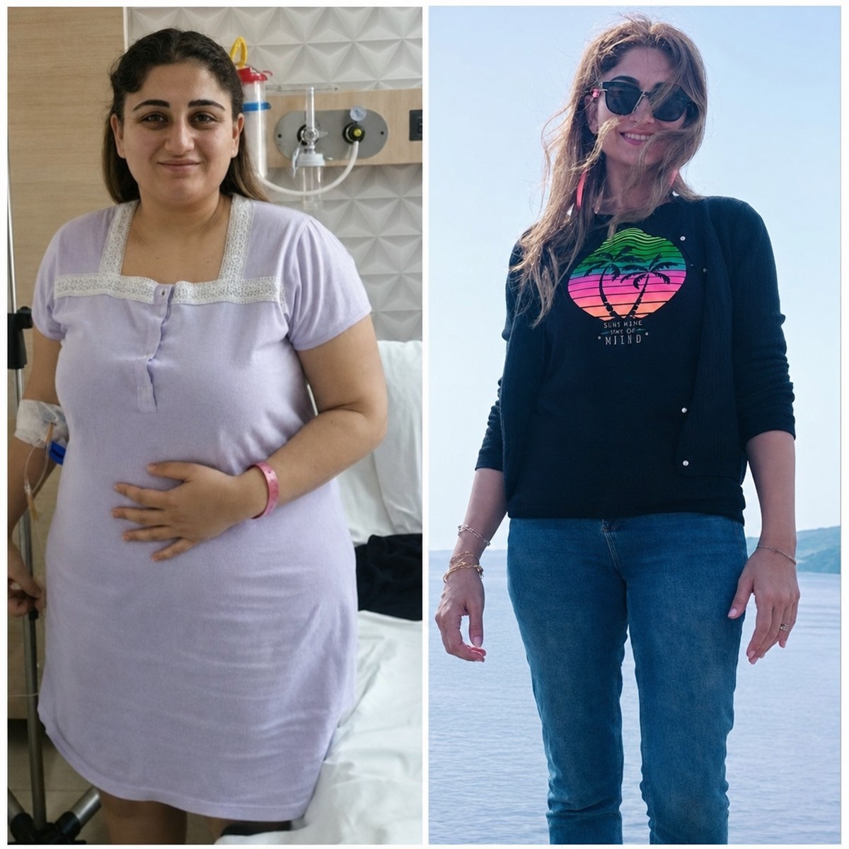 Resultados antes y después de bypass gástrico en Assoc.Prof.Dr.Cemal Kara / Medical Park İzmir Hospital