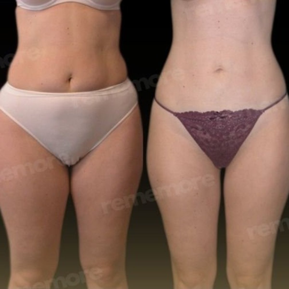 Before and after liposuction results at Memorial Göztepe Hospital, improved body contour