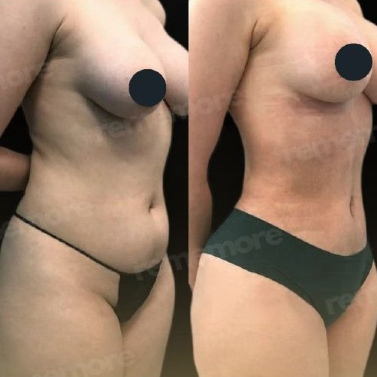Before and after liposuction results at Memorial Göztepe Hospital, improved body contour