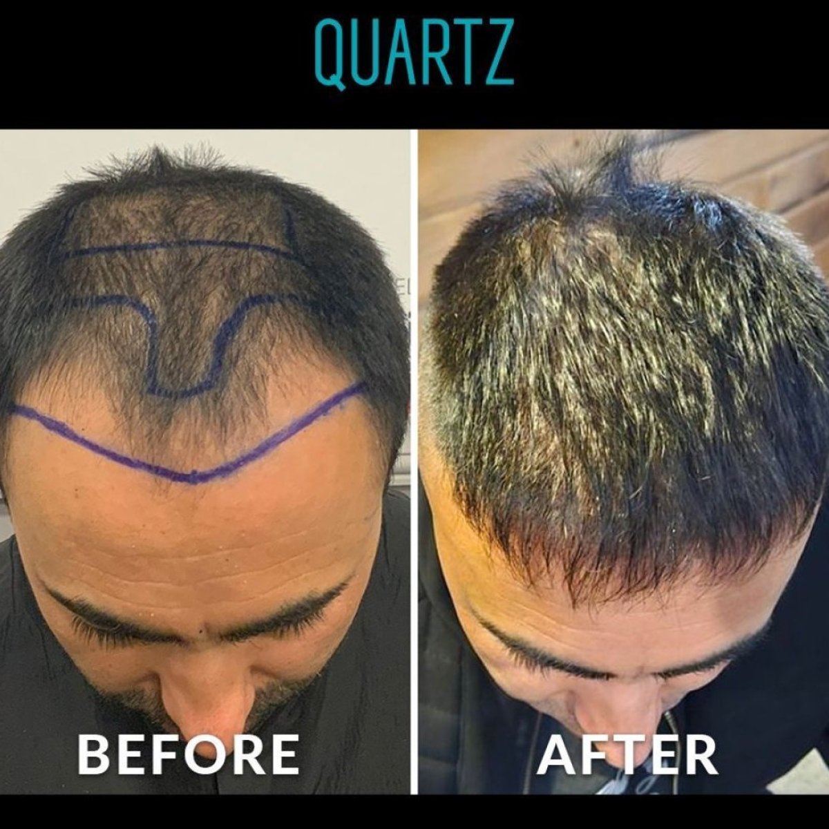Before and after No Shave Hair Transplant results at Quartz Hospital, improved hair density
