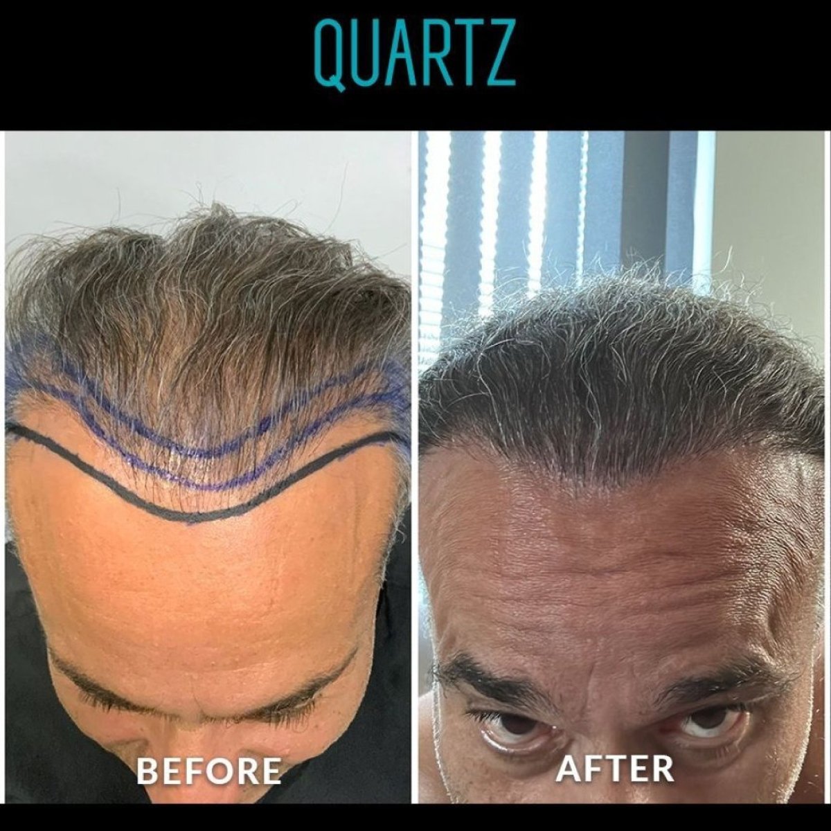 Efekty przed i po przeszczepie włosów No Shave w Quartz Hospital, odbudowana linia