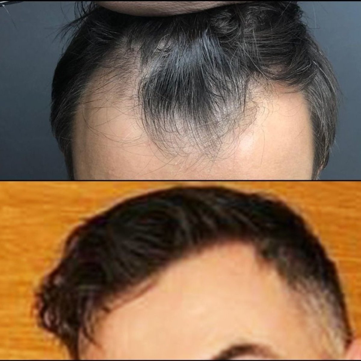 Before and after no shave hair transplant results at Quartz Hospital, restored hairline